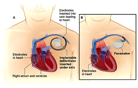 An image illustrating the comparison of an Implantable Cardioverter Defibrillator and a Pacemaker.