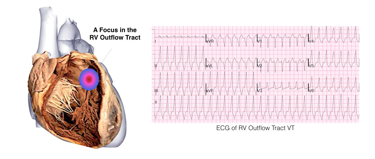 A dissection view of the heart showing a focus on the RV outflow tract with the ECG of RV outflow tract VT.