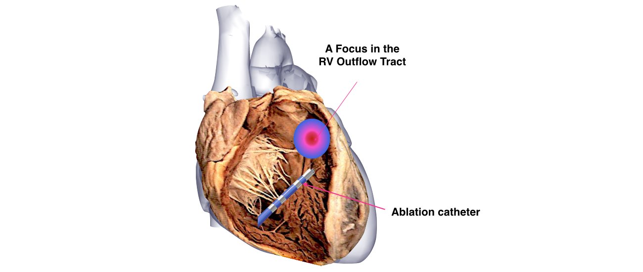 A dissection view of the heart showing a focus on the RV outflow tract with an ablation catheter.