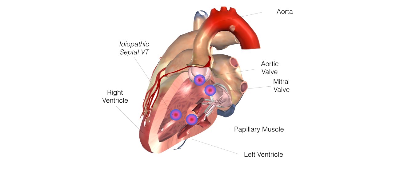 Image showing an implantable cardioverter-defibrillator (ICD) inserted in the heart.