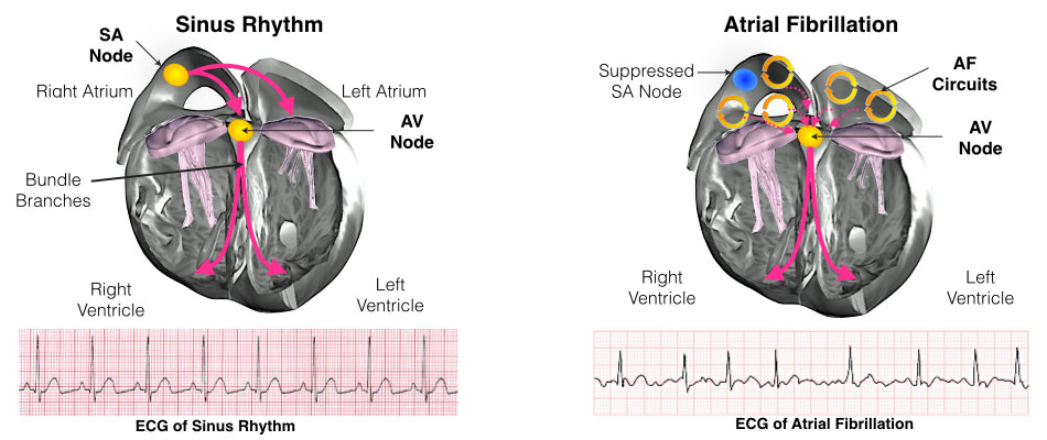 Image showing both Sinus Rhythm and atrial fibrillation.
