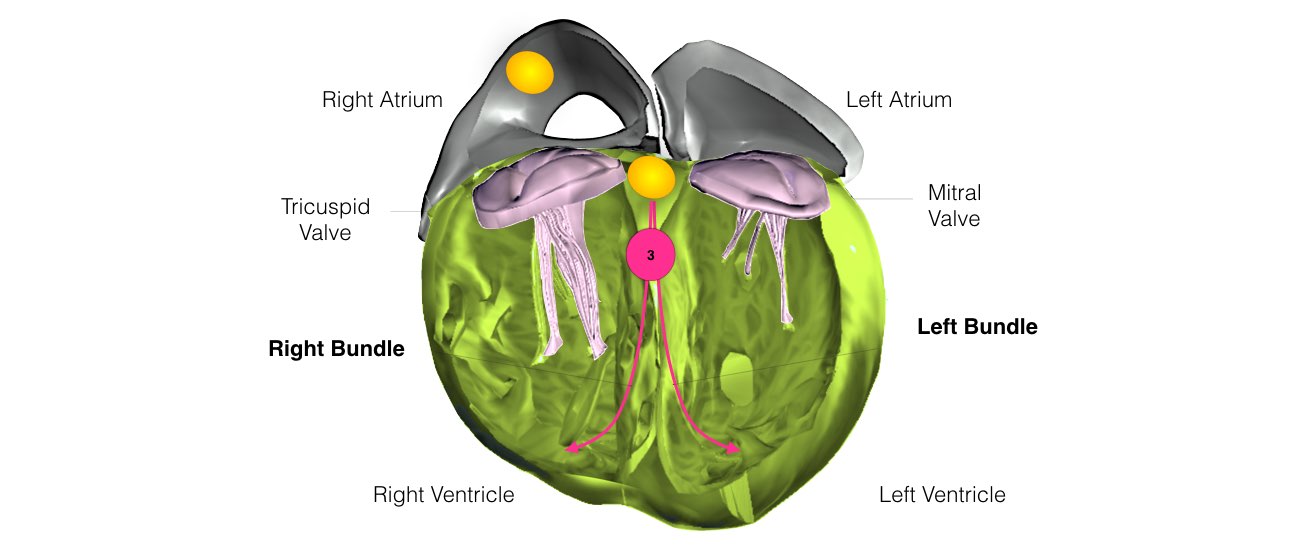 The image shows Atrial Flutter due to a short circuit in one of the upper chambers of the heart, the right atrium.