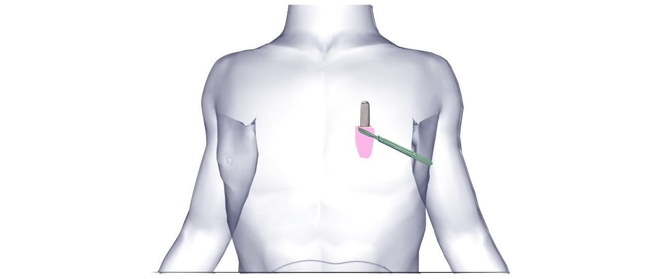 The image shows the implantable loop recorder (ILR) implanted just under the skin of the chest.