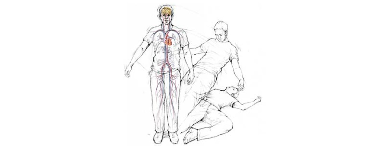 The image illustrates Syncope, or loss of consciousness.