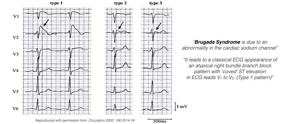 The ECG reading shows the Brugada Syndrome.