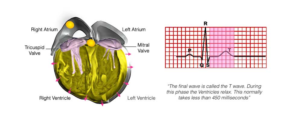 The image shows the internal structure of a heart with the SA and AV nodes and the T wave in the ECG.
