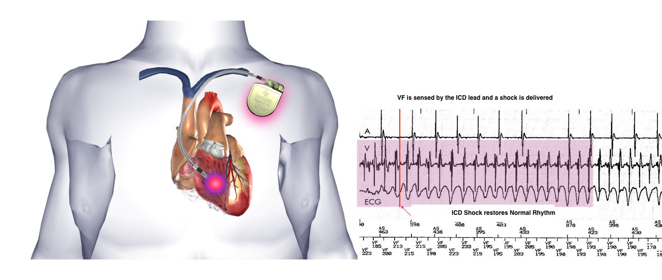 The image shows the operation of the pacemaker with ECG recordings showing the ICD shocks restoring normal rhythms.