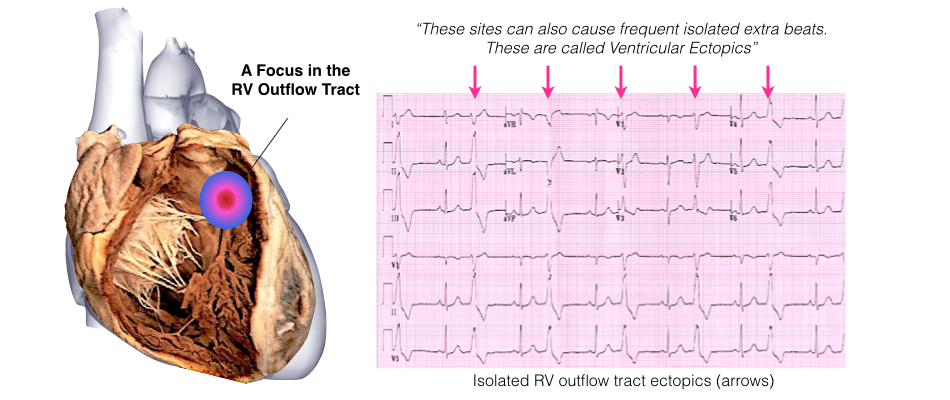 A dissection view of the heart showing a focus on the RV outflow tract with the isolated RV outflow tract ectopics.