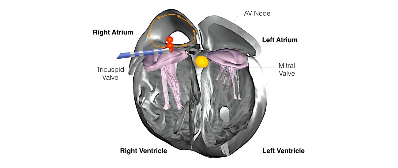 The image shows the Ablation process in the upper chamber.