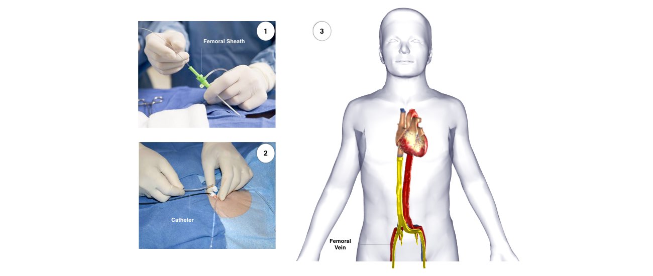 A collage of images illustrating the procedure of Atrial fibrillation.