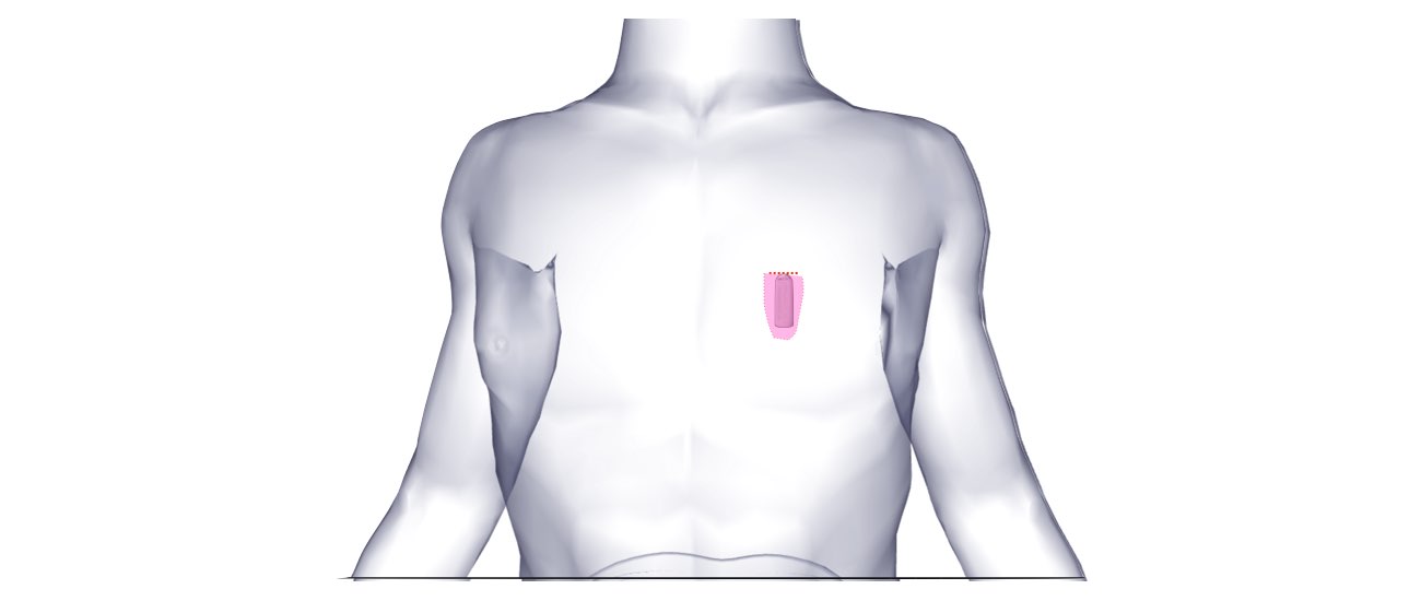 The image shows the implantable loop recorder (ILR) which is implanted just under the skin of the chest to the left of the breastbone. 