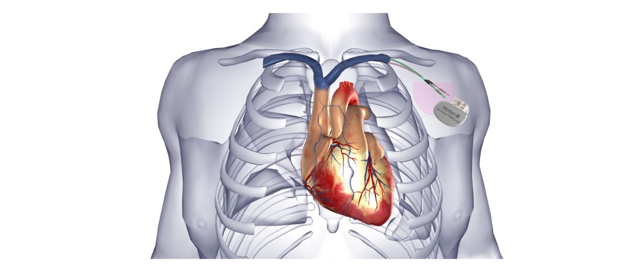The image shows the heart inside the rib cage with an implanted pacemaker.
