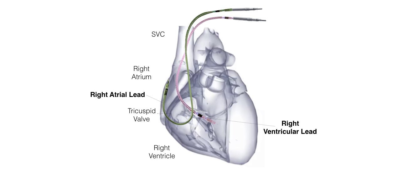 The image of a heart shows the right atrial lead and the right ventricular lead.