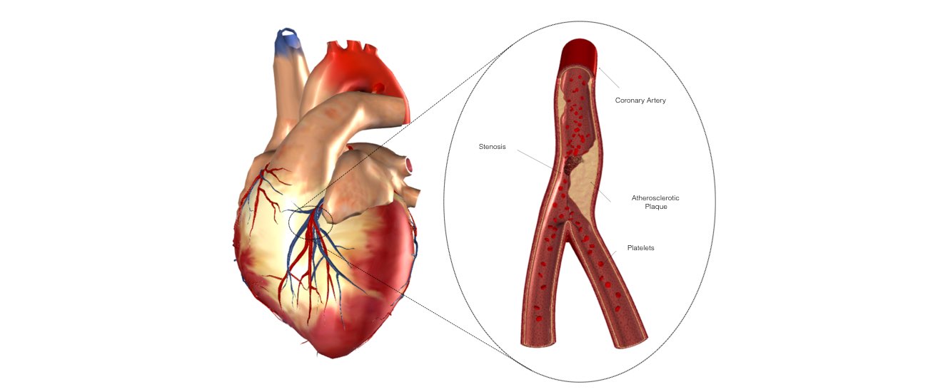 Image of a heart with a dissection inner image showing the development of scar tissue. 
