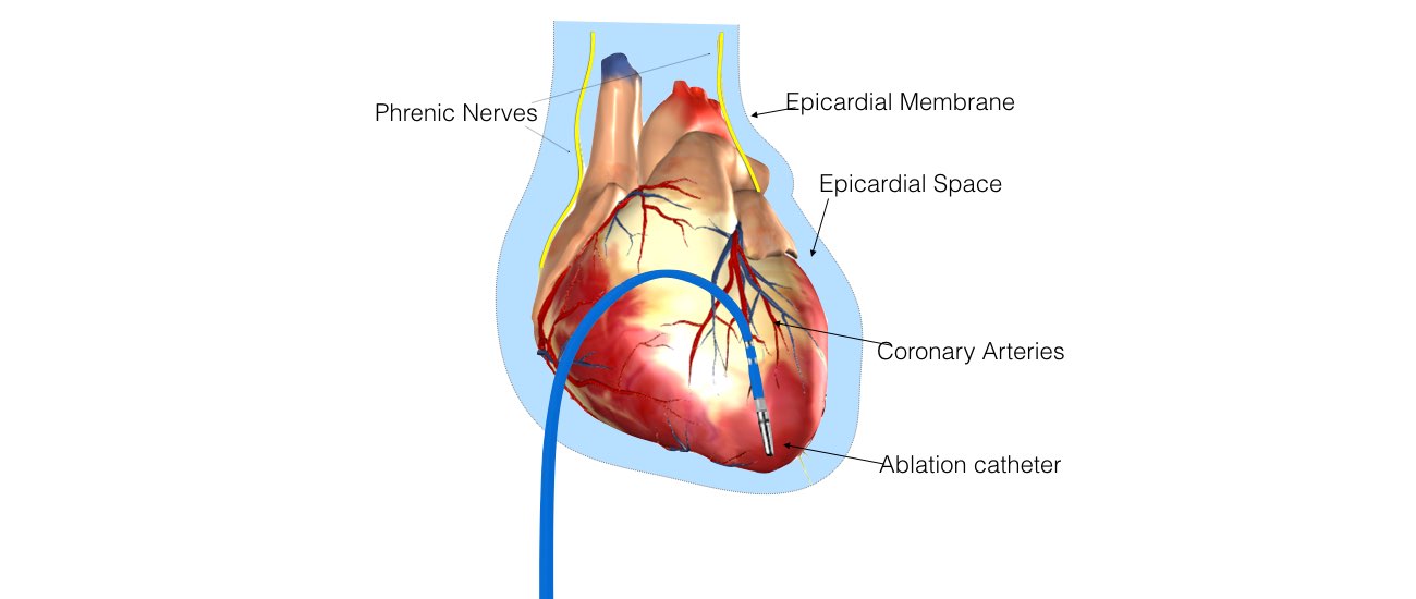 The image shows the heart inside the rib cage and the ablation catheter in the VT ablation procedure.