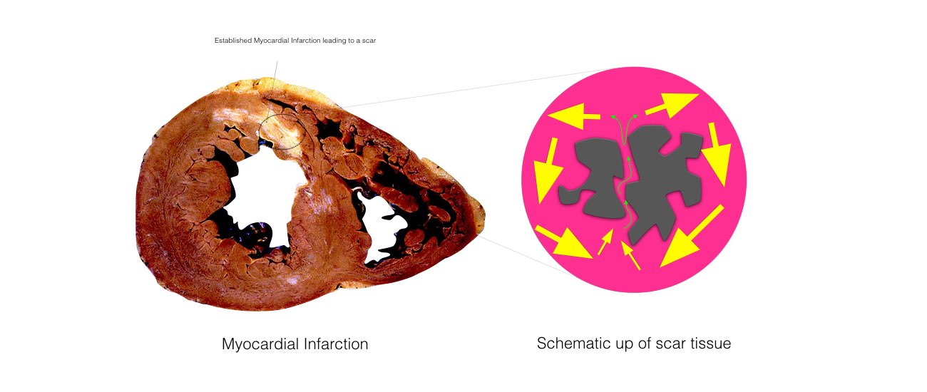 Image showing the Myocardial Infarction and schematic up of scar tissue.