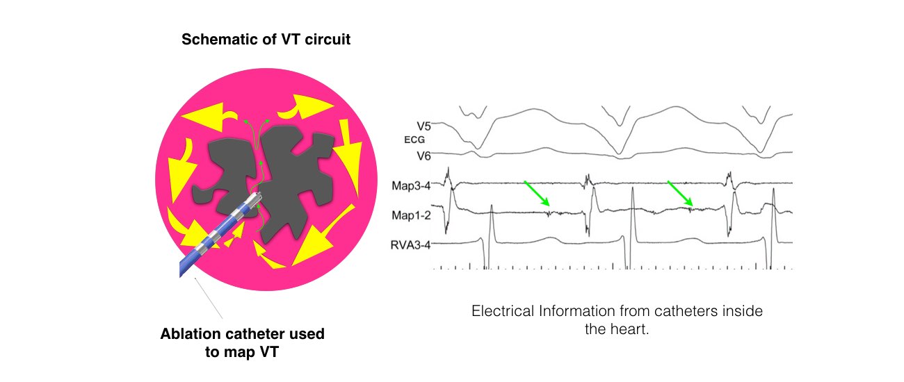 The image shows the ablation catheter used to map VT and the electrical information from the catheters inside the heart.