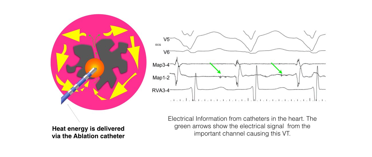 The image shows the heat energy delivered via the ablation catheter and the electrical information from the catheters inside the heart.