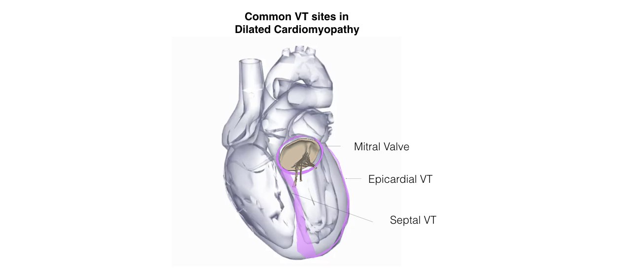 The image of a heart shows the common VT sites in dilated Cardiomyopathy.