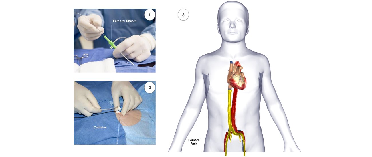 The collage image shows the Radiofrequency Ablation Procedure.