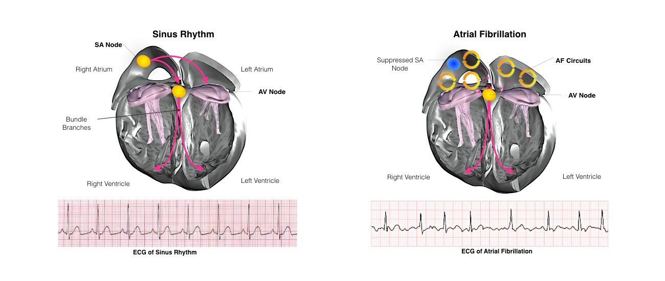 Image showing a comparison between Sinus Rhythm & Atrial fibrillation.
