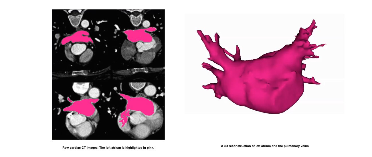 Raw cardiac CT image and a 3D reconstruction of the left atrium and the pulmonary veins