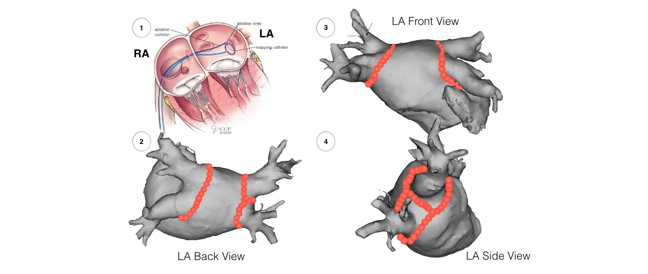 Image showing the back & side view of the left atrium.