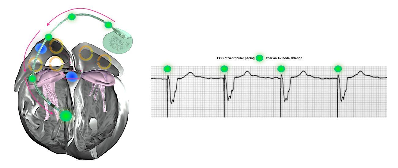 The image shows the implantation of a pacemaker for the multiple short circuits in the upper chambers of the heart and the ECG of ventricular pacing after an AV node ablation.