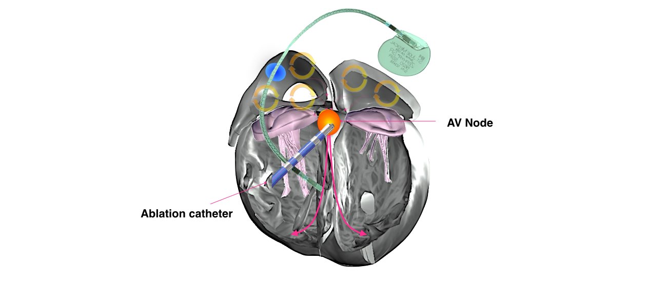 The image shows the implantation of a pacemaker with an ablation catheter and AV node.