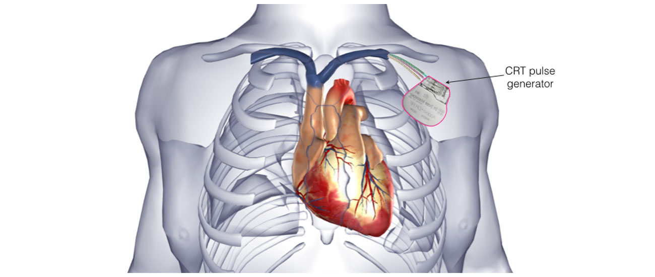 The image shows a heart with an implanted CRT pulse generator.
