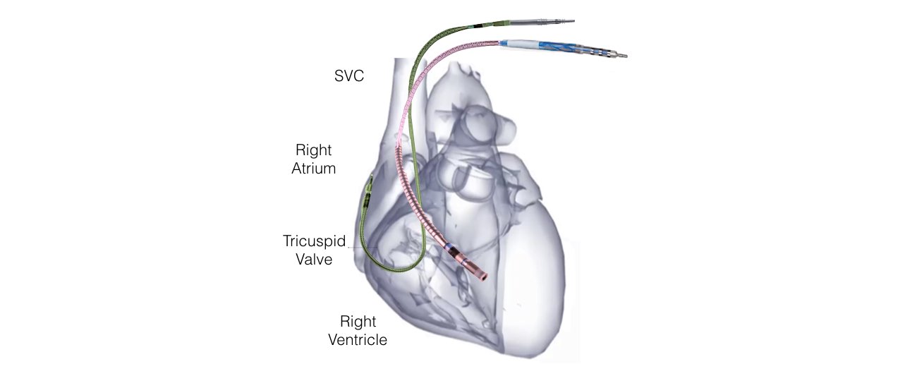 The image shows the internal structure of a heart with the SA and AV nodes and the Atrial activation represented by the P-wave in the ECG.