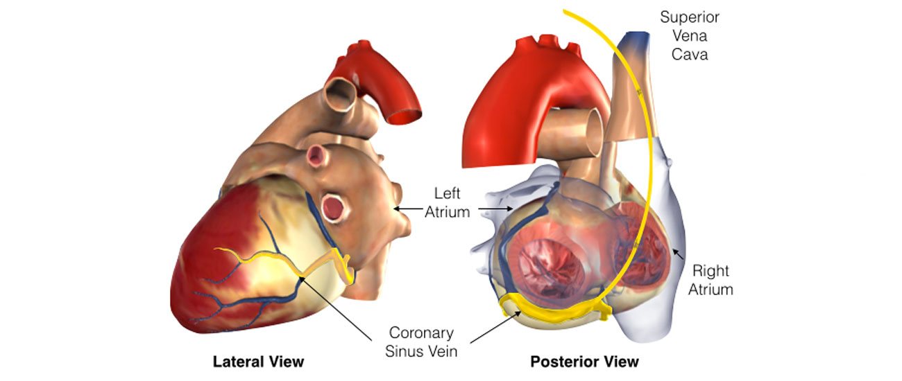 The lateral and posterior view of the heart after implanting the CRT pulse generator.