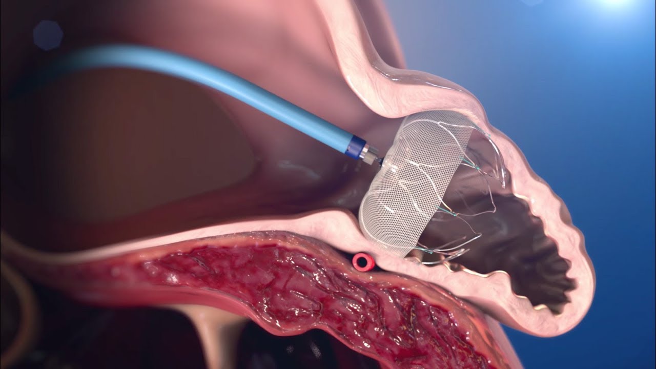 Close-up image of a special catheter in the heart.