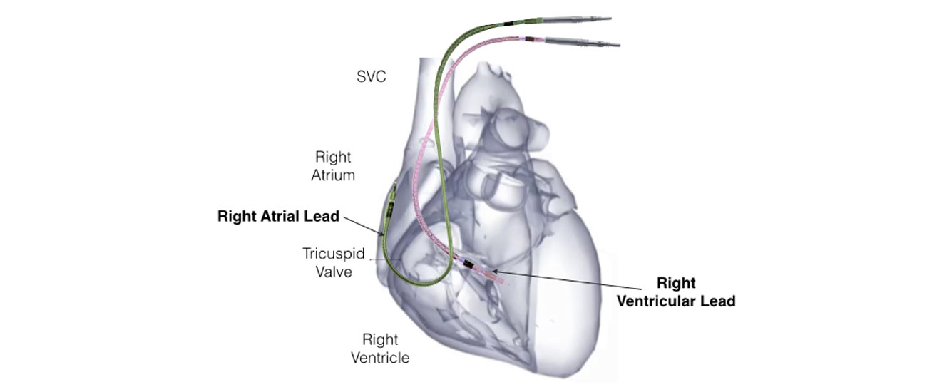 Picture of a heart with the right atrial lead and left atrial lead.